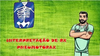 Interpretação de RX Pneumotórax e Hemotórax Maciço [upl. by Arde204]