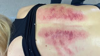 WOW 😱 The Gua Sha Lights Up Her Back Crunching A Teacher With Scoliosis To Help Her BACK [upl. by Silden]