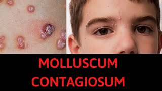 What is Molluscum Contagiosum Symptoms Treatment [upl. by Theurich]