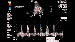 Normal Renal Artery Flow  Case Study [upl. by Cykana406]