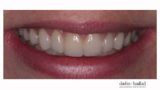 quotMy porcelain veneers are so natural lookingI love themquot [upl. by Rustice]