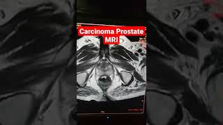 Carcinoma Prostate on MRI Scan [upl. by Ahseikal926]