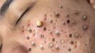 ACNE TREATMENT VU QUYNH MI Blackheads Removal Popping [upl. by Acissev]