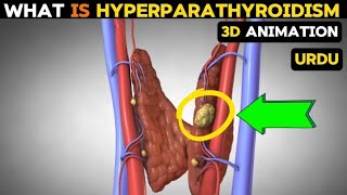 What is hyperparathyroidism causessymptoms and treatment [upl. by Dhruv]