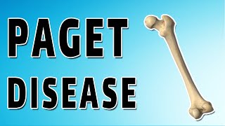 Pagets Disease doctor radiology medical [upl. by Nylaf]