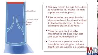 Treatment For Varicose Veins [upl. by Niwri]