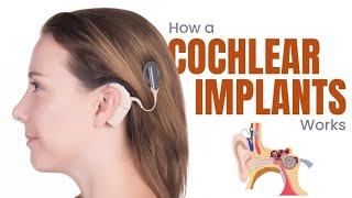 Cochlear Implants What are they and How do they work  3D Guide [upl. by Ominoreg]