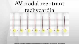 AV nodal reentrant tachycardia [upl. by Forras]