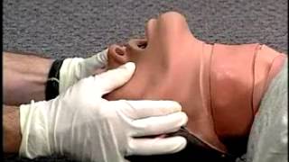 HIPEREXTENSION Y SUBLUXACION MANDIBULAR [upl. by Vijar]