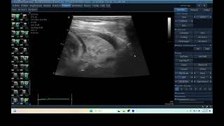 IQ 290 TFAST LUNG MASS ULTRASOUND ICP CPP ECHOPAC ANALYSIS 0 [upl. by Nerraf]