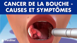 CANCER DE LA BOUCHE  Causes symptômes et types de tumeurs buccales © [upl. by Mccormick]