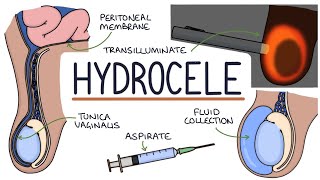 Hydrocele  Drk [upl. by Yrrad398]