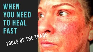 FULL FACE FIBROBLAST HEALING [upl. by Aneeram]