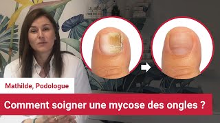 Soigner et reconnaitre la mycose des ongles des pieds  Conseil dune podologue [upl. by Yttiy549]