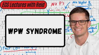 WolffParkinsonWhite Syndrome  Day 17 ECG Challenge [upl. by Gennaro]