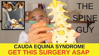 Treatment for Cauda Equina Syndrome [upl. by Budworth481]