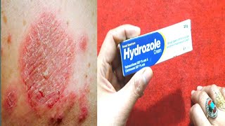 Hydrozole Cream Benefits And Uses Stop Skin itching Fungl  Khooni Kharish By Sanam [upl. by Cock]