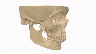 Jaw Contouring  Customized 3d Printed Guides [upl. by Isaac974]