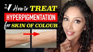 DOCTOR Vs HOW TO TREAT HYPERPIGMENTATION for SKIN OF COLOUR  BROWN DARK SKINCARE  DR V soc [upl. by Suryt]