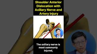 Shoulder Dislocation Axillary with Nerve and Artery injury [upl. by Conal]