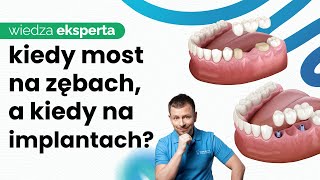 MOSTY NA IMPLANTACH KIEDY MOST NA ZĘBACH A KIEDY NA IMPLANTACH ZALETY MOSTÓW NA IMPLANTACH [upl. by Batsheva]