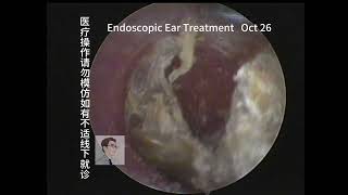 Endoscopic treatment of bilateral fungal external otitis 20231026 [upl. by Fulbert]