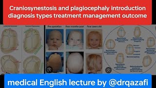 Craniosynestosis and plagiocephaly introduction diagnosis types treatment management outcome [upl. by Fara]