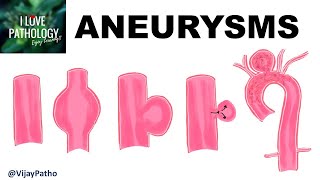 ANEURYSMS Types  Pathogenesis amp Abdominal aortic aneurysm [upl. by Anikas]