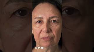 Oculoplastica  Prima e Dopo Ptosis Asimmetria palpebre Blefaroplastica 2 0 [upl. by Miguelita]