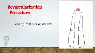 Revascularization procedure in open apex cases [upl. by Etac]