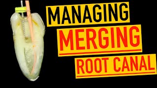 Managing a Joining root canal  4K Resolution [upl. by Studner]