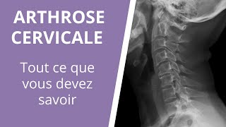 Tout ce que vous devez savoir sur larthrose cervicale  causes symptômes et traitements [upl. by Ondrej542]