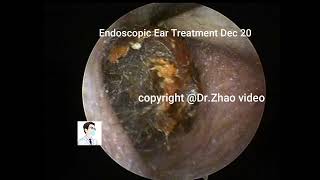 Ear wax removal，Re examination and cleaning of cholesteatoma [upl. by Alatea]