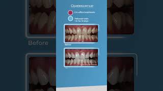 Opalescence™ Boost™ and Opalescence™ PF  Case Study [upl. by Noelani]