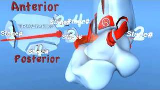 Lauge Hansen PER Pronation External Rotation Eversion Ankle Fracture [upl. by Eahsed888]