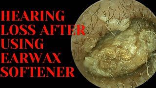 Hearing LOSS After Using Earwax Softener [upl. by Ytsirhc]