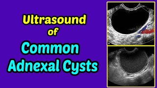 Ultrasound of Common Adnexal Cysts [upl. by Flore406]