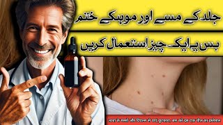 Use Iodine for Skin Tags and Warts  डॉक्टर ज़ी 👨🏻‍⚕DrKashif Bilal [upl. by Enaid]