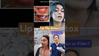 botox lip flip before and after [upl. by Ekram]