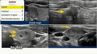 How to calculate TIRADS score for thyroid lesion [upl. by Yancy]