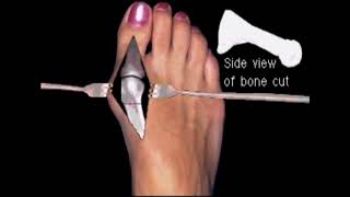 Austin bunionectomy with Akin osteotomy Moderate bunion correction surgery [upl. by Sibyl137]