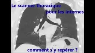 Les bronches en scanner pour les internes [upl. by Torres]