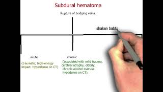 Subdural hematoma neurology 81  First Aid USMLE Step 1 in UrduHindi [upl. by Lienet]