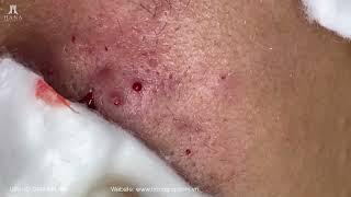 Big Cystic Acne Blackheads Extraction Blackheads amp Milia Whiteheads Removal Pimple Popping [upl. by Sim]