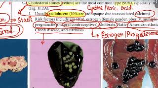 Biliary Atresia Cholelithiasis from first aid step 1USMLEUrduHindi [upl. by Natal]