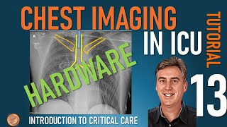 Chest Imaging in ICU  Part 2  Hardware [upl. by Haiacim742]