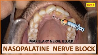 NASOPALATINE NERVE BLOCK PART5 MAXILLARY NERVE BLOCK ORAL SURGERY dentalcafe4331 [upl. by Westland]