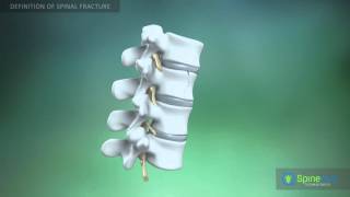 Spinal fractures Definition [upl. by Tingey516]