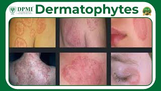 Dermatophyte Infection Types Of Dermatophytes Dermatophyte Symptoms Diagnosis And Treatment [upl. by Norrat222]