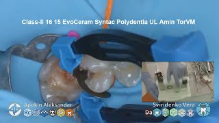 Caries classII 16 15 EvoCeram Syntac Polydentia UL Amin TorVM FHD multistream [upl. by Uhn]